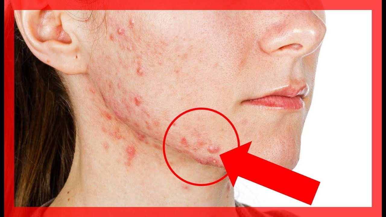 10 remedios caseros para el acné que si funcionan
