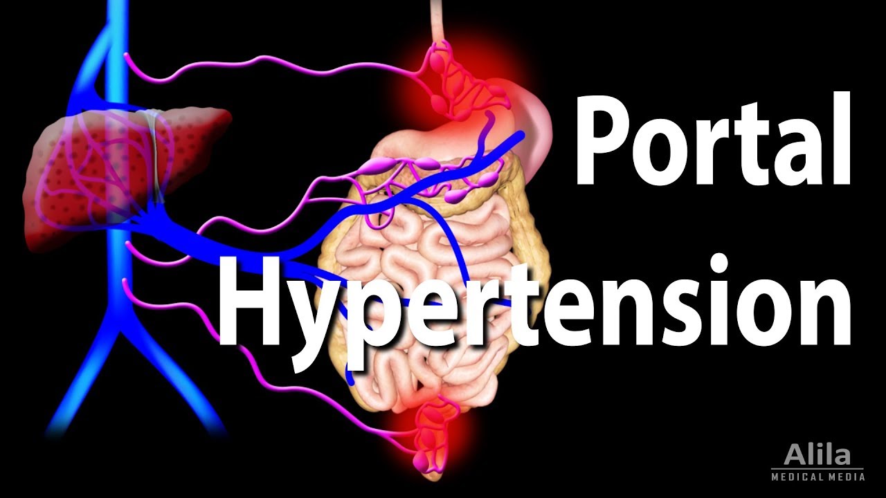 Portal Hypertension, Animation