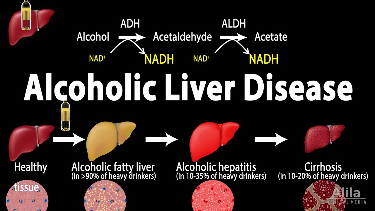 Alcoholic Liver Disease, Animation