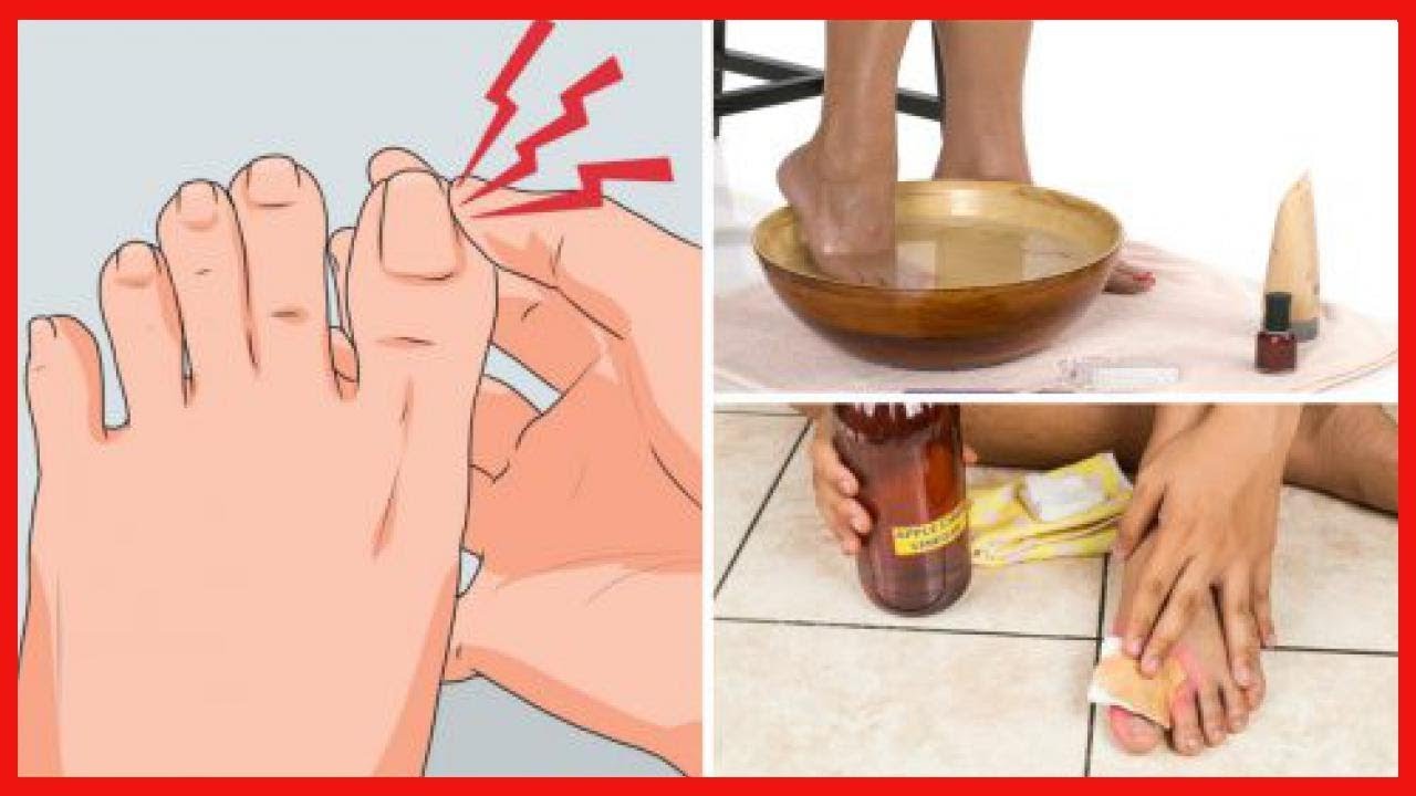 Combate las uñas encarnadas con estos 6 remedios caseros
