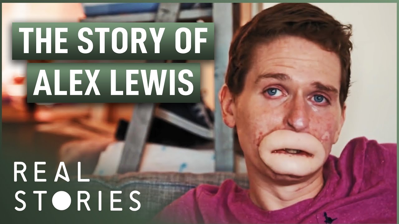 L'affaire Extraordinaire d'Alex Lewis (Documentaire de Miracle Médical) - Real Stories