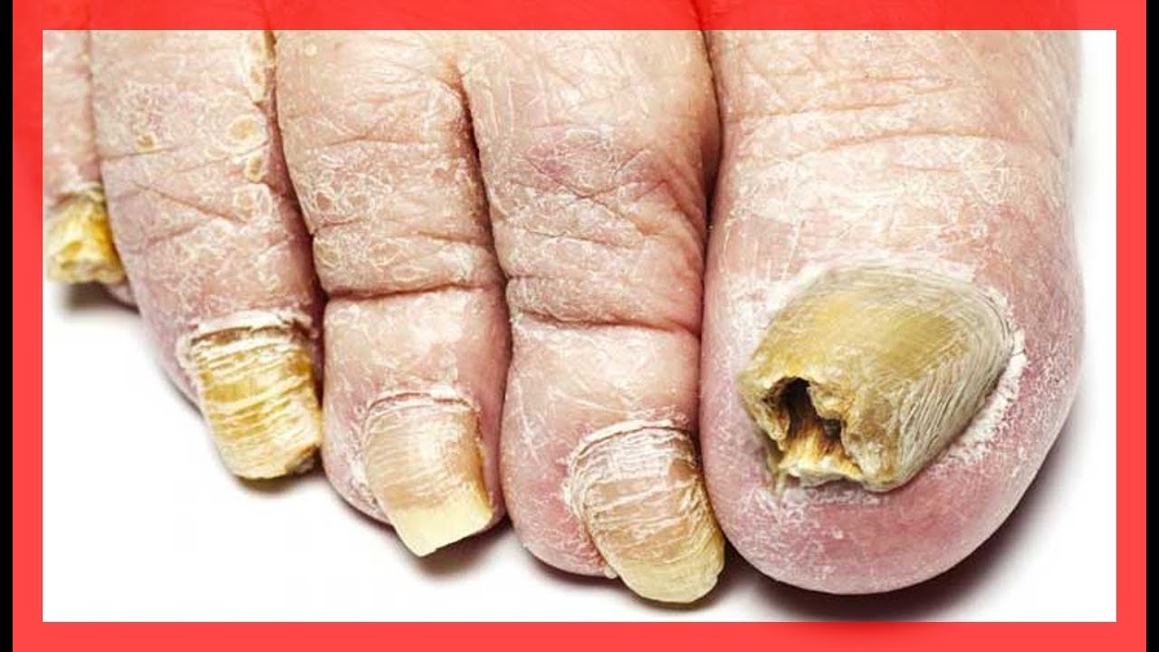 Remedios caseros para hongos en las uñas de los pies y manos con efectividad comprobada