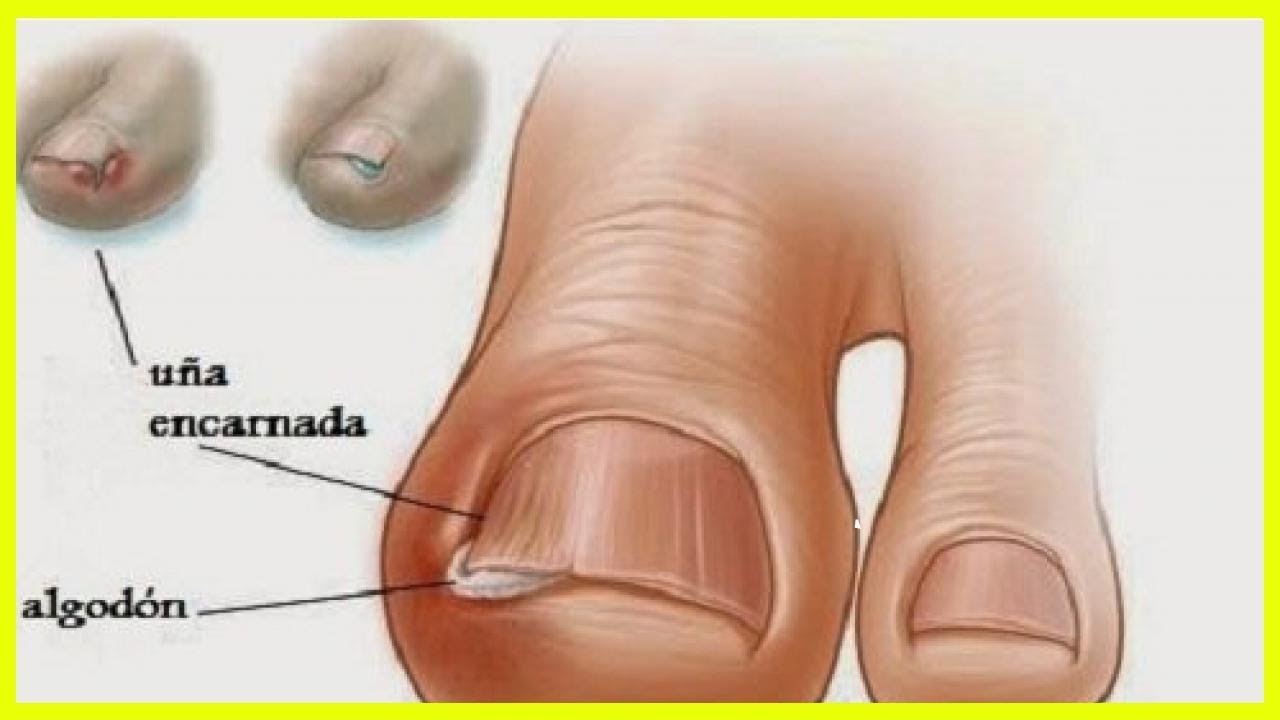 Tratamiento casero para uñas encarnadas del pie