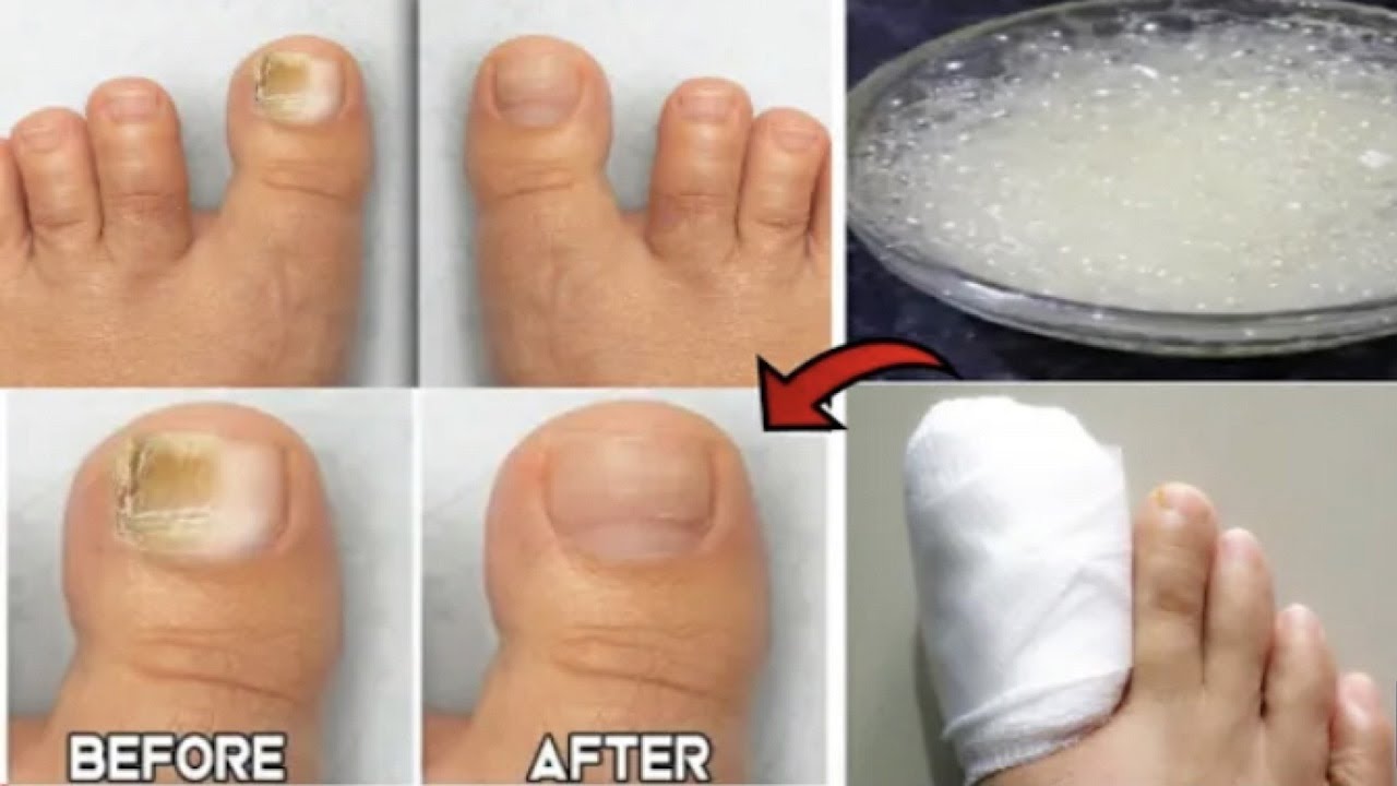¡Eliminar hongos uñas pies rápidamente, dile adiós a onicomicosis en una semana!