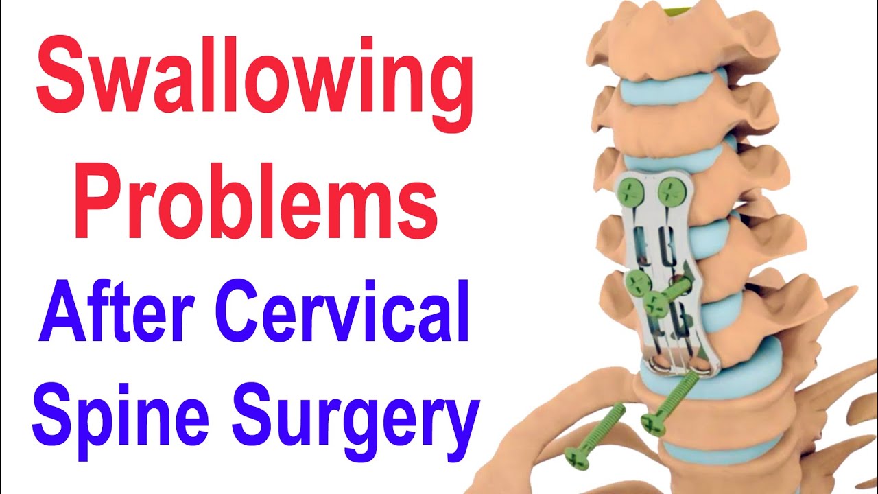 Problèmes de déglutition après une chirurgie du rachis cervical (ACDF)