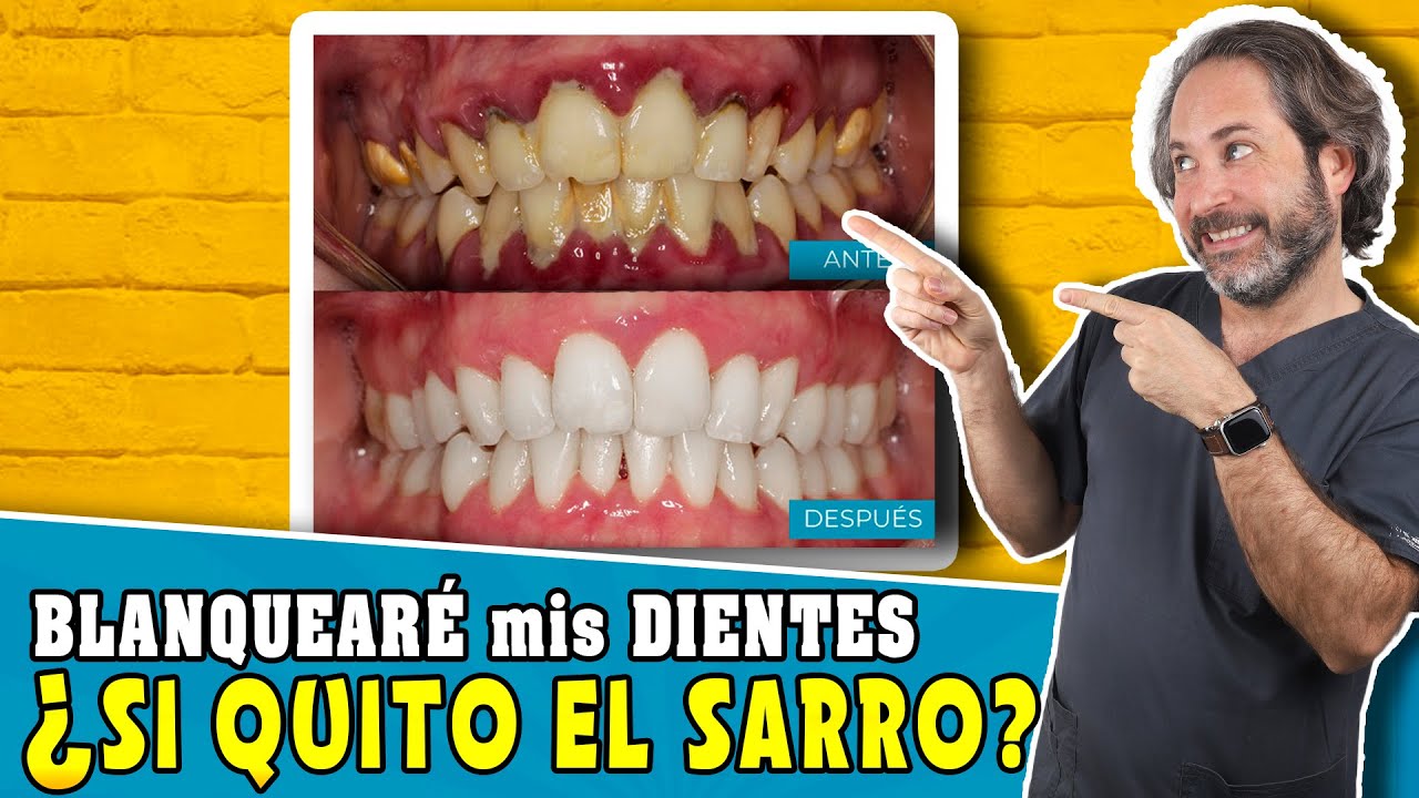 ¿Una 🧼 LIMPIEZA DENTAL 𝗕𝗟𝗔𝗡𝗤𝗨𝗘𝗔 los dientes? Como 𝗤𝗨𝗜𝗧𝗔𝗥 el 𝗦𝗔𝗥𝗥𝗢💩 DE LOS DIENTES y BLANQUEARLOS