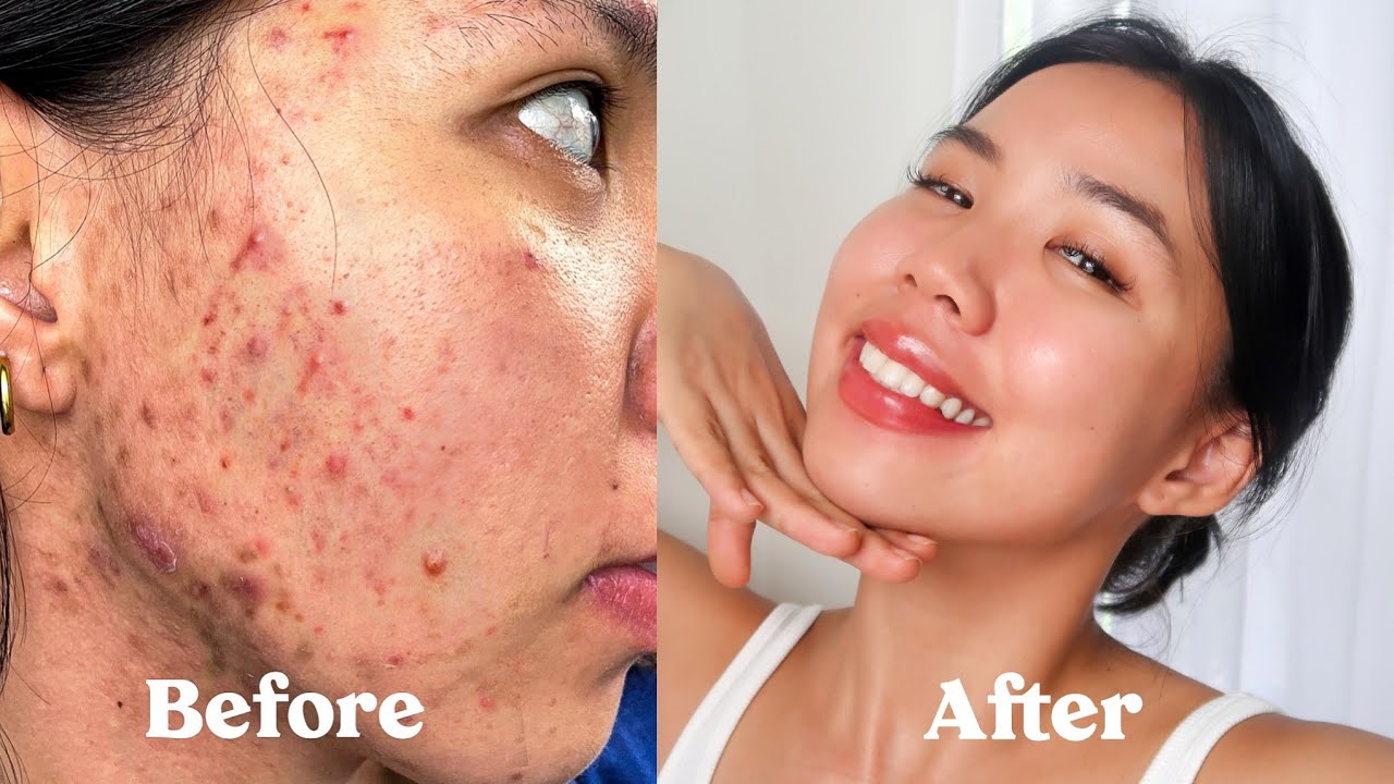 (ENG SUB) HOW I GOT RID OF MY ACNE, SCARS, TEXTURE \u0026 HYPERPIGMENTATION *not sponsored*