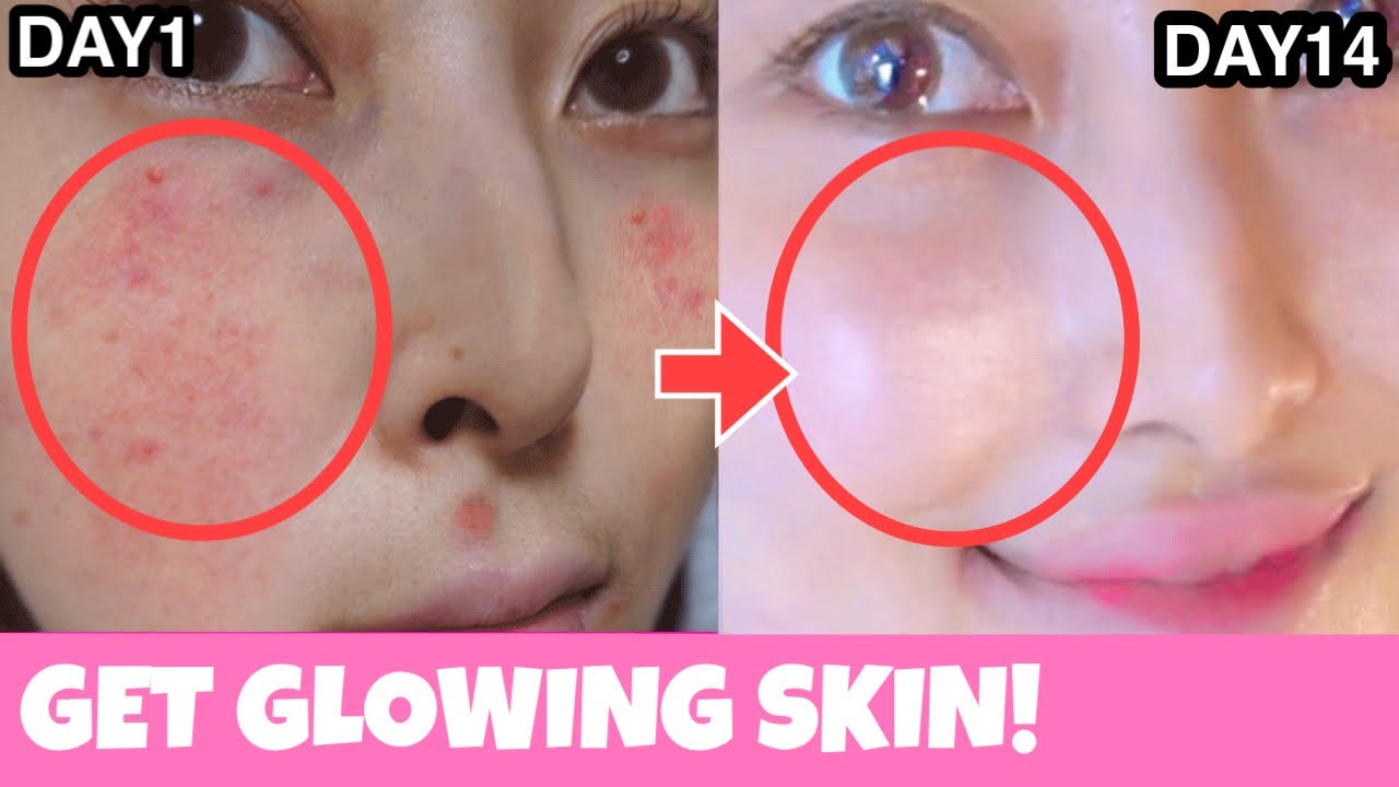 Exercices faciaux pour une peau éclatante ! Prévenir l'acné, les cicatrices, la pigmentation | Anti-âge, Lifting du visage