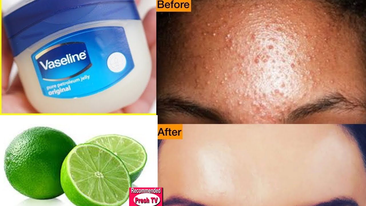 Hoe puistjes te verwijderen 's nachts / acne behandeling Verwijder puistjes' s nachts vaseline en