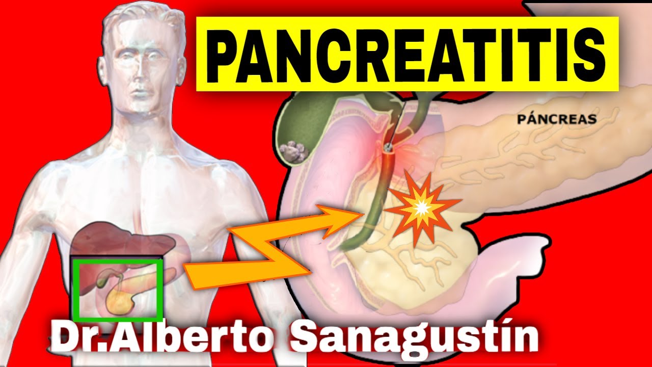 PANCREATITIS AGUDA (y CRÓNICA): Síntomas, Causas y Tratamiento