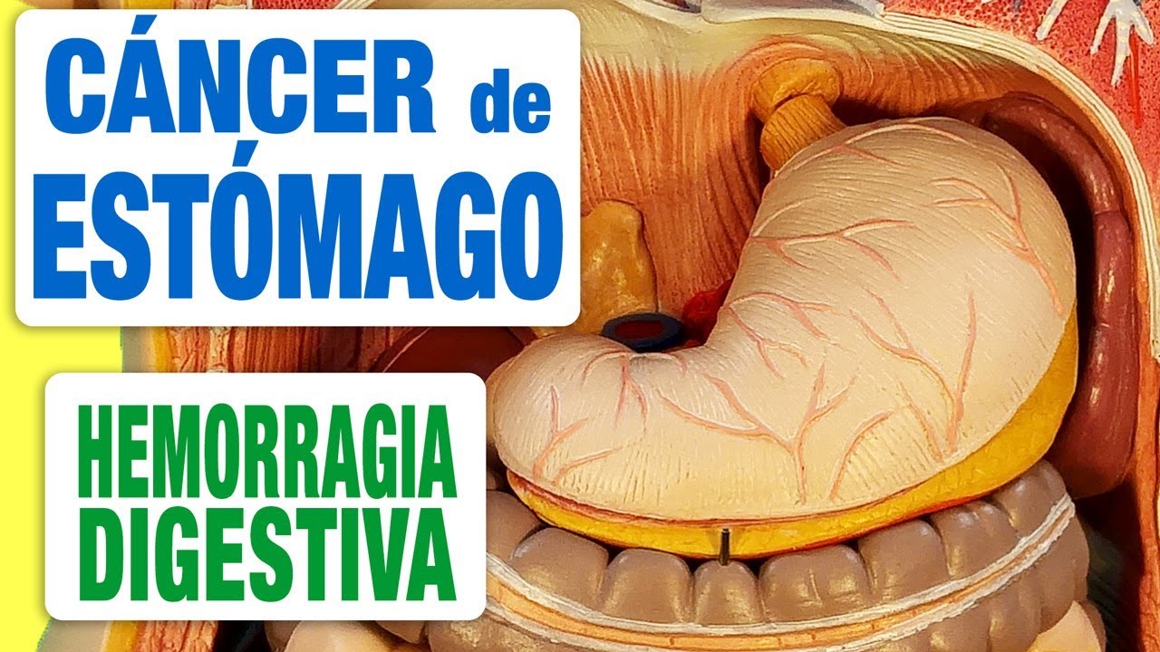 Síntomas del cáncer de estómago - Hemorragia digestiva
