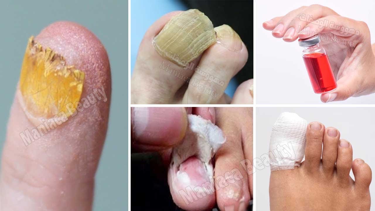 Do you suffer from nail fungus Take my experience ✅*** VERY IMPORTANT TIP *** | NASTY NAIL FUNGUS!