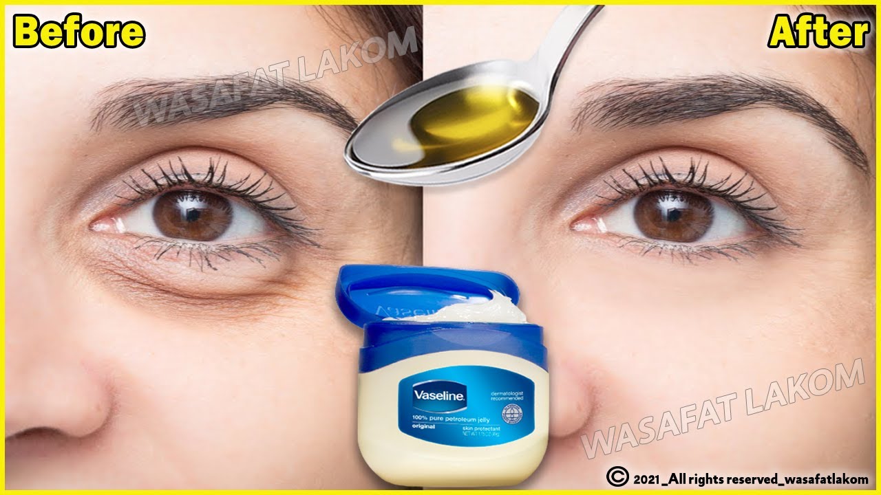 In 3 days Remove Under Eye Bags Completely | Remove Dark Circle, Wrinkles, Puffy Eyes