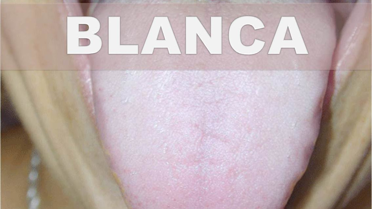 ☞ Remedios caseros para la lengua blanca – Como eliminar o quitar capa blanca de la lengua