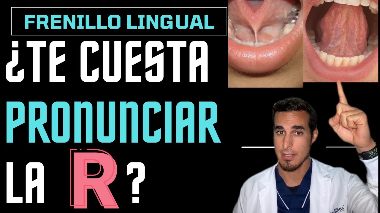 ¿Te cuesta PRONUNCIAR la letra R? - Frenillo lingual corto